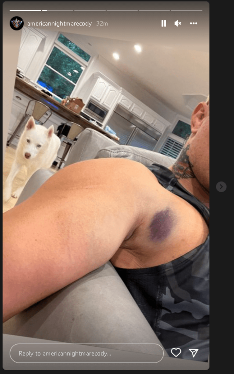 Cody Rhodes Shows Off The Bruising Progression Of His Torn Pec (Photos)