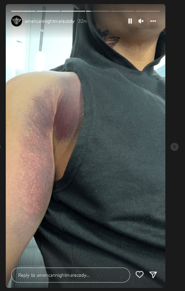 Cody Rhodes Shows Off The Bruising Progression Of His Torn Pec (Photos)